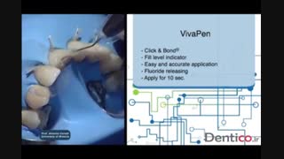 کامپوزیت IVOCLAR VIVADENT - IPS Empress Direct