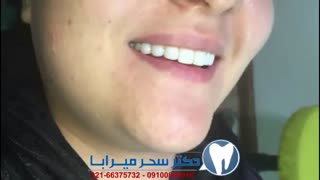 نمونه کارهای دکتر سحر میرآبا: اصلاح طرح لبخند، پالیش کردن دندان ها