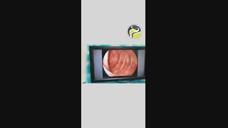 اهمیت استفاده از آندوسکوپ های با کیفیت  و با دقت بالا در تشخیص بیماری های گوارشی