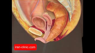 درمان فیستول با لیزر و جراحی در ایران کلینیک