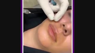 تزریق ژل لب توسط دکتر یلدا عطارزاده منافذ باز پوست