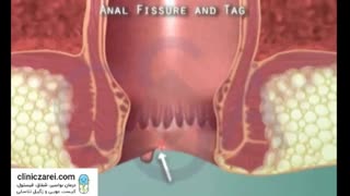 معاینه و تشخیص بیماری شقاق در کلینیک زارعی