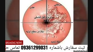 درمان زگیل_تناسلی و تبخال_تناسلی