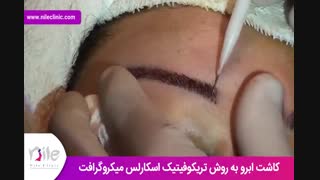 کاشت ابرو | فیلم کاشت ابرو | کلینیک پوست و مو نیل | شماره 17