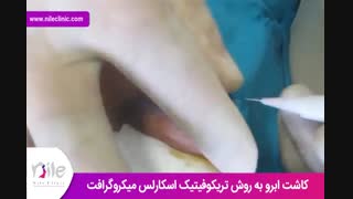 کاشت ابرو | فیلم کاشت ابرو | کلینیک پوست و مو نیل | شماره 18