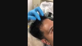 درمان ریزش شدید مو