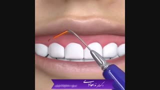 جراحی لبخند لثه