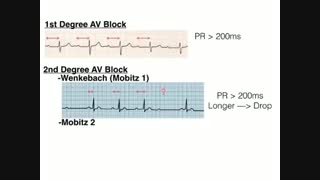 تفسیر نوار قلب  /بلوکهای قلبی بلوکهای گره av