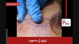 تزریق ژل | فیلم تزریق ژل | کلینیک پوست و مو هلیا | شماره 16