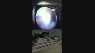 بازسازی رباط ACL