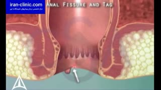 خطر بروز بواسیر یا همورئید در بین افراد شاغل - ایران کلینیک