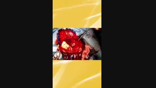 جراحی تومور مغزی