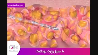 لیپوماتیک | فیلم لیپوماتیک | کلینیک پوست و مو نیل | شماره 17