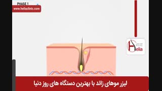 لیزر موهای زائد | فیلم لیزر موهای زائد | کلینیک پوست و مو هلیا | شماره 18