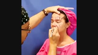 جراحی لیفت صورت کربوکسی تراپی