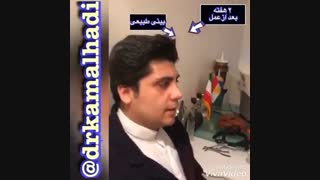 جراح بینی گوشتی در تهران