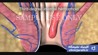 درمان بواسیر یا هموروئید در کلینیک نشیمنگاه clinicjarahi.ir با دکتر و پزشک متخصص