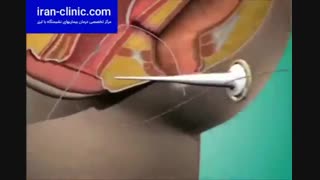 مزایای درمان فیستول با لیزر در ایران کلینیک