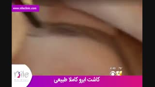 کاشت ابرو | فیلم کاشت ابرو | کلینیک پوست و مو نیل | شماره 21