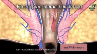 هزینه جراحی بواسیربا لیزر در تهران و کرج