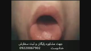 درمان قطعی زگیل تناسلی