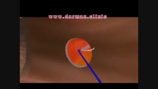 درمان فیستول با لیزر - درمان کلینیک روکش دندان