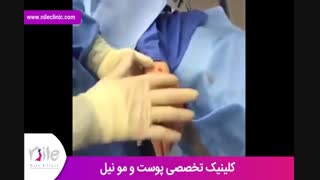 تزریق چربی | فیلم تزریق چربی | کلینیک پوست و مو نیل | شماره 15