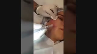 میکرونیدلینگ ترمیم زیبایی دندان