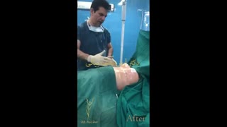 لیفت سینه (ماموپلاستی)