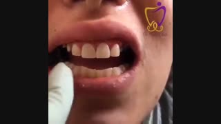 ترکیب کامپوزیت و روکش سرامیکی