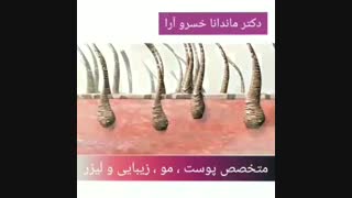 فیلم تاثیر لیزر برای از بین بردن موهای زائد