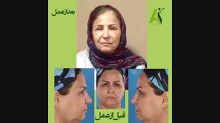 نمونه کار جراحی بلفاروپلاستی