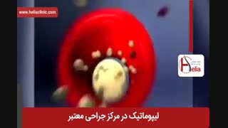 لیپوماتیک | فیلم لیپوماتیک | کلینیک پوست و مو هلیا | شماره 21