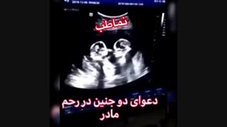 دعوای دو جنین در رحم مادر