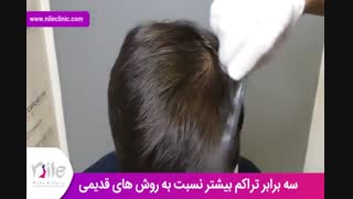 کاشت مو | فیلم کاشت مو | کلینیک پوست و مو نیل | شماره 20