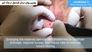 بهترین روش درمان فیستول در ونک لیزر  https://vanaklaser.ir/