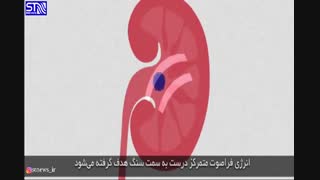 از سنگ کلیه در امان بمانید