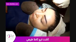 کاشت ابرو | فیلم کاشت ابرو | کلینیک پوست و مو نیل | شماره 22