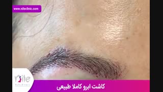 کاشت ابرو | فیلم کاشت ابرو | کلینیک پوست و مو نیل | شماره 23
