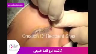 کاشت ابرو | فیلم کاشت ابرو | کلینیک پوست و مو نیل | شماره 24