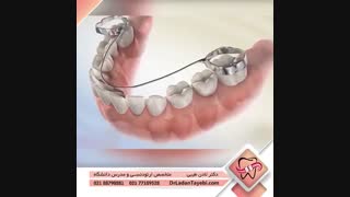 فضا نگهدار ارتودنسی | دکتر طیبی