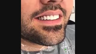 تعویض روکش چهار دندان قدامی و کامپوزیت ونیر سایر دندانها برای اصلاح