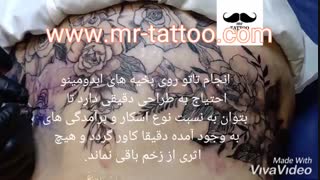 تاتو ابدومینوپلاستی