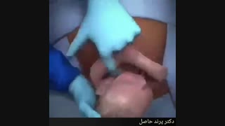نحوه بخیه سزارین