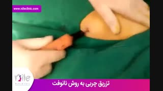 تزریق چربی | فیلم تزریق چربی | کلینیک پوست و مو نیل | شماره 16