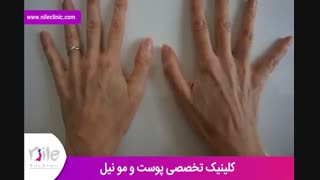 تزریق چربی | فیلم تزریق چربی | کلینیک پوست و مو نیل | شماره 18