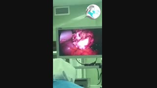 عمل لاپاراسکوپی میومکتومی