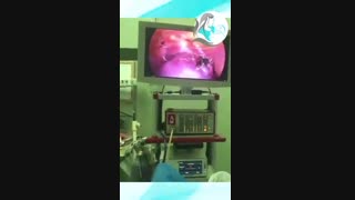 درآوردن رحم با لاپاراسکوپ