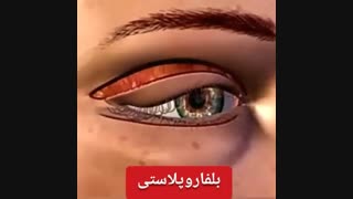 جراحی زیبایی پلک