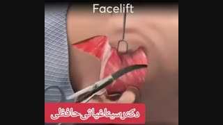 عمل لیفت صورت برای چه افرادی توصیه میشود ؟